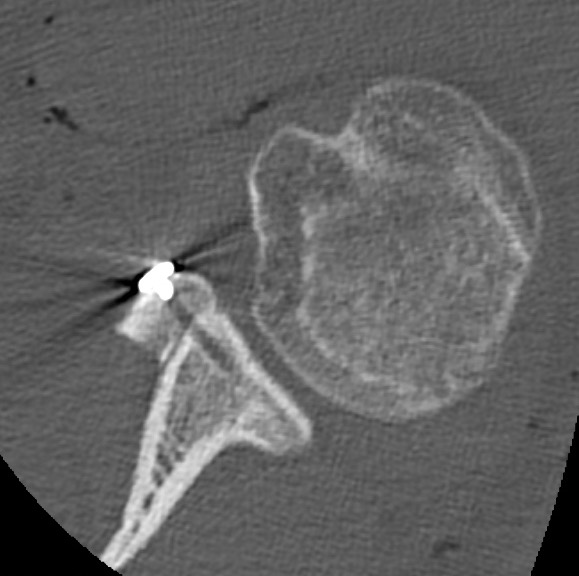 Butée Latarjet (fixation par double endobouton) Luxation de l'épaule traumatique au sport traitement par chirurgie sous arthroscopie parstabilisation type Latarjet ou Bankart par le docteur Christophe Charousset IOAPC Paris en chirurgie ambulatoire