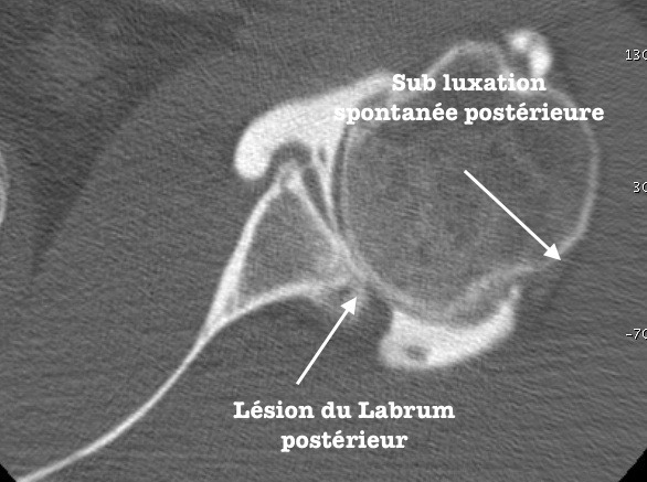 Arthroscanner de l'épaule: lésion du Labrum ou bourrelet postérieur Luxation postérieure de l'épaule Luxation de l'épaule traumatique au sport traitement par chirurgie sous arthroscopie parstabilisation type Latarjet ou Bankart par le docteur Christophe Charousset IOAPC Paris en chirurgie ambulatoire