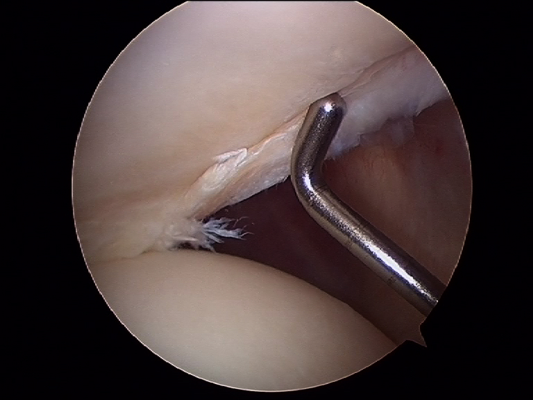Arthroscopie de l'épaule: fissure du Labrum postérieur Luxation postérieure de l'épaule Luxation de l'épaule traumatique au sport traitement par chirurgie sous arthroscopie parstabilisation type Latarjet ou Bankart par le docteur Christophe Charousset IOAPC Paris en chirurgie ambulatoire