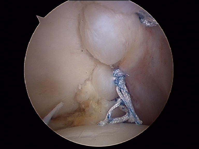 Arthroscopie de l'épaule: suture du Labrum postérieur Luxation postérieure de l'épaule Luxation de l'épaule traumatique au sport traitement par chirurgie sous arthroscopie parstabilisation type Latarjet ou Bankart par le docteur Christophe Charousset IOAPC Paris en chirurgie ambulatoire