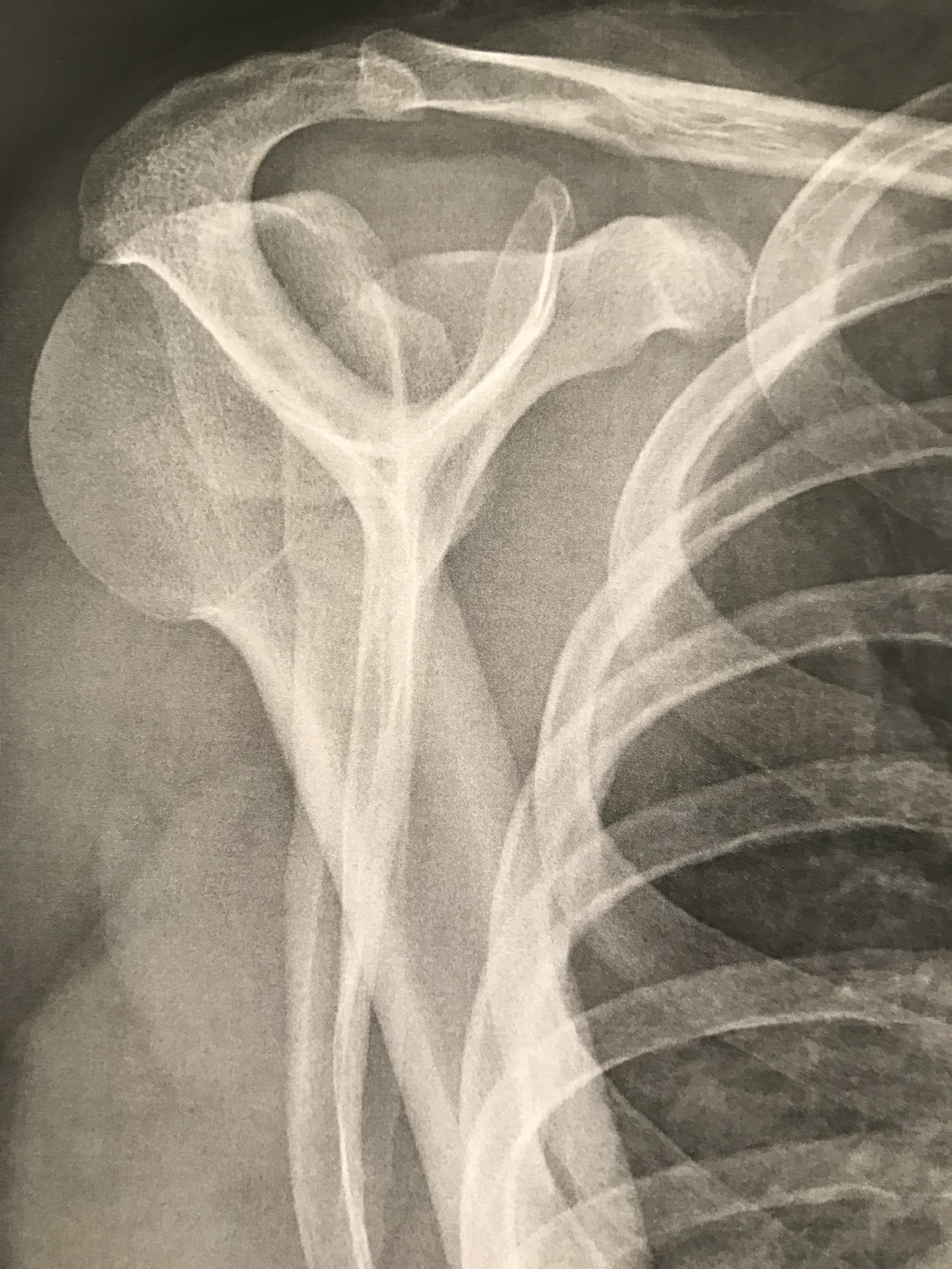 Radiographie d'une luxation postérieure de l'épaule Luxation postérieure de l'épaule Luxation de l'épaule traumatique au sport traitement par chirurgie sous arthroscopie parstabilisation type Latarjet ou Bankart par le docteur Christophe Charousset IOAPC Paris en chirurgie ambulatoire