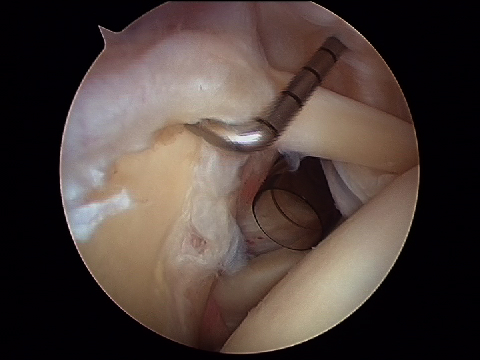 Arthroscopie de l'épaule: désinsertion supérieur du pieds du Biceps (Slap lesion) Luxation de l'épaule traumatique au sport traitement par chirurgie sous arthroscopie parstabilisation type Latarjet ou Bankart par le docteur Christophe Charousset IOAPC Paris en chirurgie ambulatoire