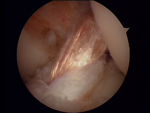 Ligamentoplastie du LCA type SAMBBA Image