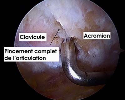 arthropathie acromio claviculaire de l'épaule douleurs chez le sportif traitement médical par infiltration de corticoide et traitement chirurgical par résection distale de la clavicule sous arthroscopie par le docteur Christophe Charousset IOAPC PARIS