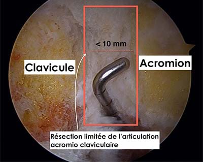 arthropathie acromio claviculaire de l'épaule douleurs chez le sportif traitement médical par infiltration de corticoide et traitement chirurgical par résection distale de la clavicule sous arthroscopie par le docteur Christophe Charousset IOAPC PARIS